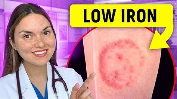 Can low iron cause bruising?