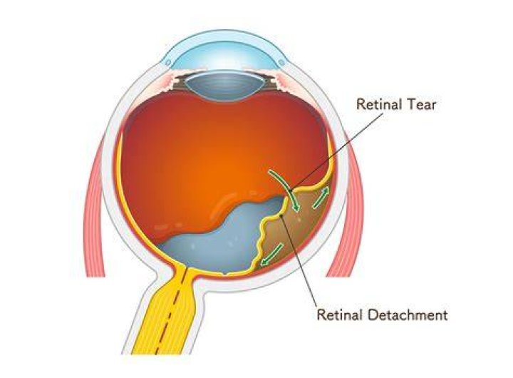 Can you feel a retinal tear?