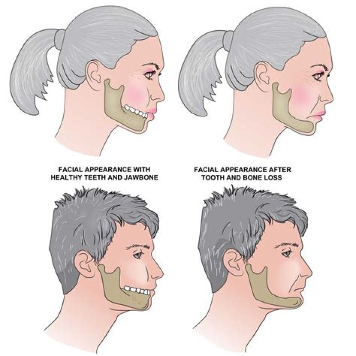 Do wisdom teeth affect your jawline?