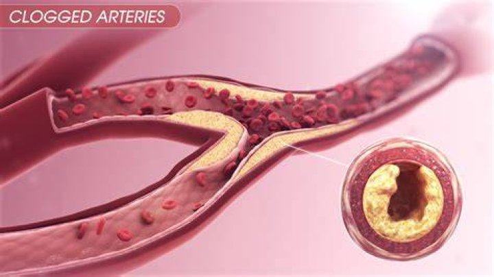 How can I tell if my arteries are clogged?