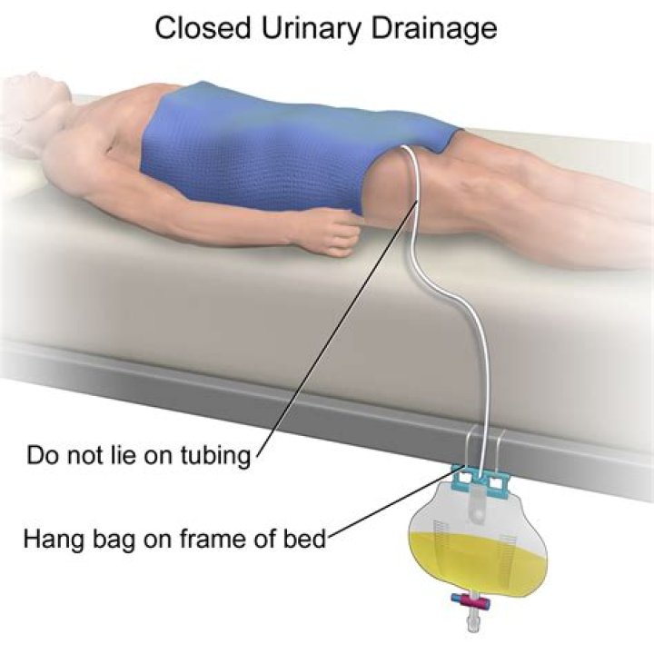 How do you sleep with a catheter in?