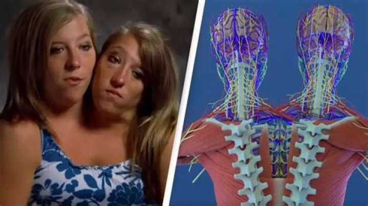 The Extraordinary Anatomy Of Abby And Brittany Hensel: A Biomedical Exploration