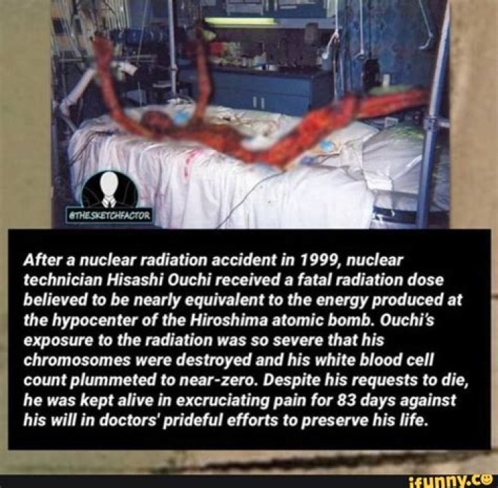 The Real Photos Of Hisashi Ouchi: A Sad Reminder Of The Devastating Effects Of Radiation