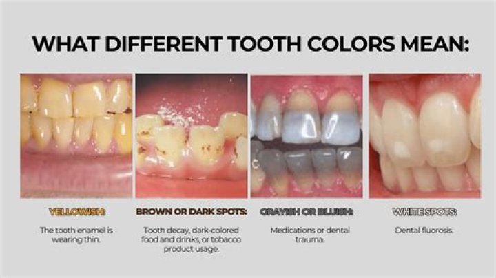 What causes grey spots on teeth?