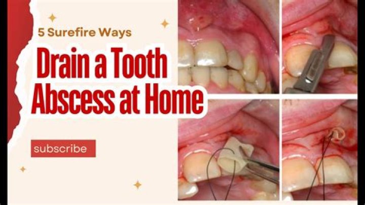 Will the ER drain an abscess tooth?